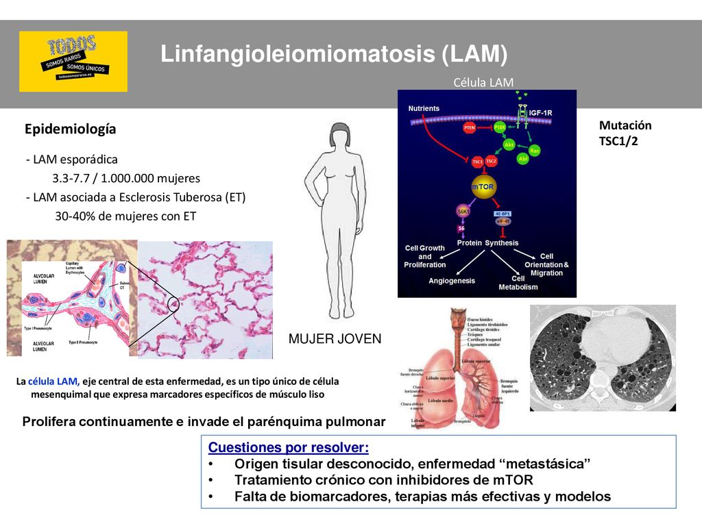 Estudio Traslacional De La Linfangioleiomiomatosis Origen Tisular Modelos In Vivo Y Estrategias Terapeuticas Alvaro Casanova Espinosa Servicio De Neumologia Ppt Descargar