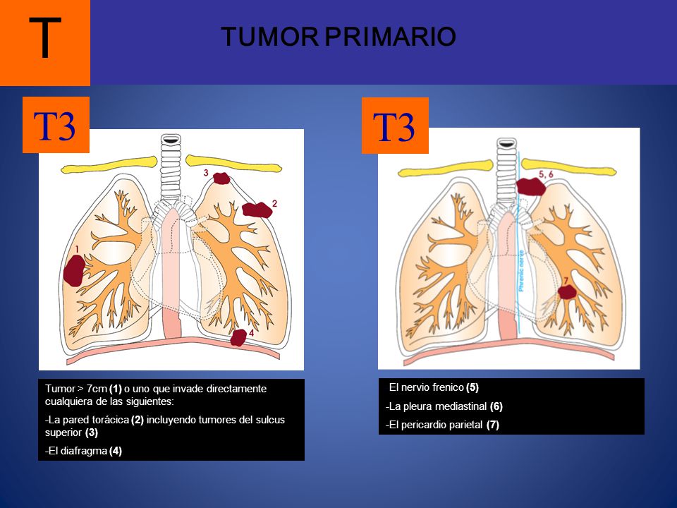 TUMOR PRIMARIO T. T3. T3. Tumor > 7cm (1) o uno que invade directamente cualquiera de las siguientes:
