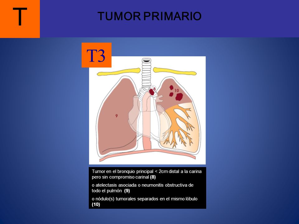 TUMOR PRIMARIO T. T3. Tumor en el bronquio principal < 2cm distal a la carina pero sin compromiso carinal (8)