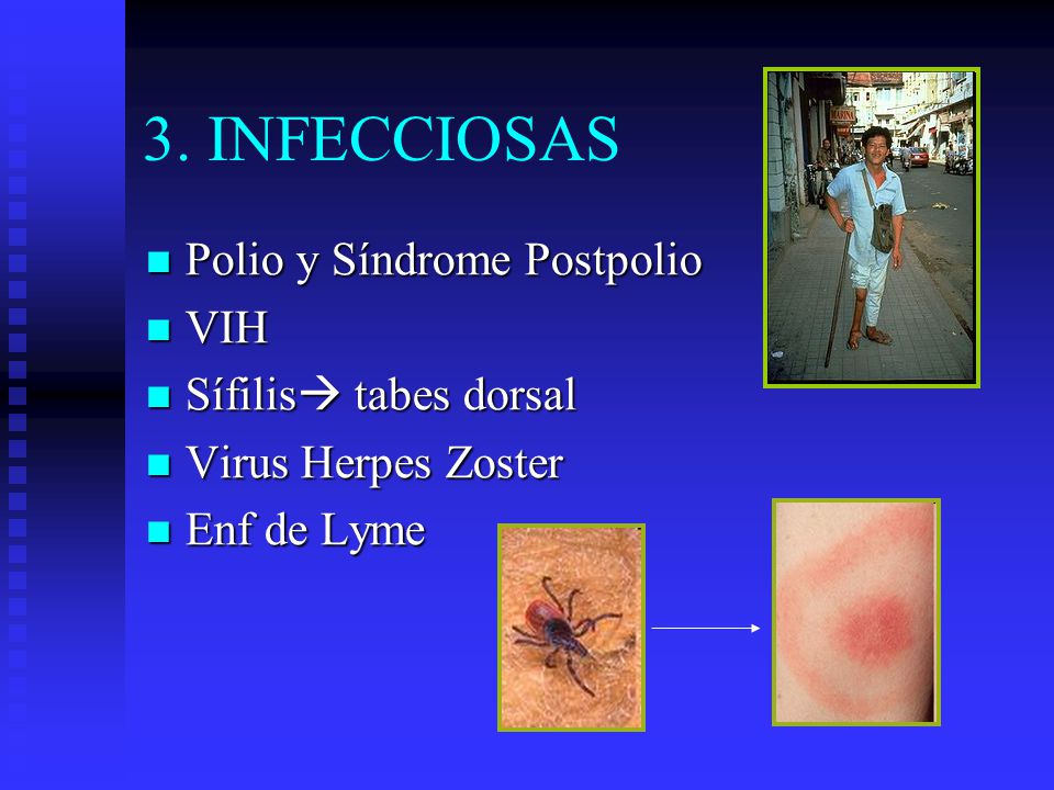 3. INFECCIOSAS Polio y Síndrome Postpolio VIH Sífilis tabes dorsal