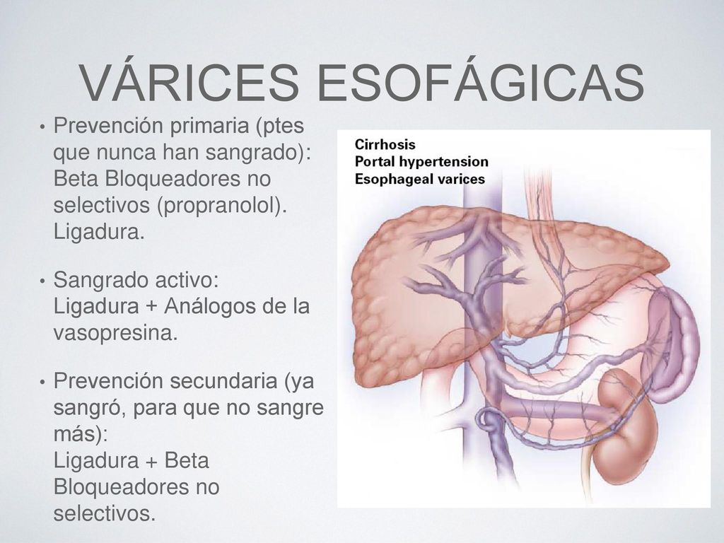 Várices esofágicas Prevención primaria (ptes que nunca han sangrado): Beta Bloqueadores no selectivos (propranolol). Ligadura.