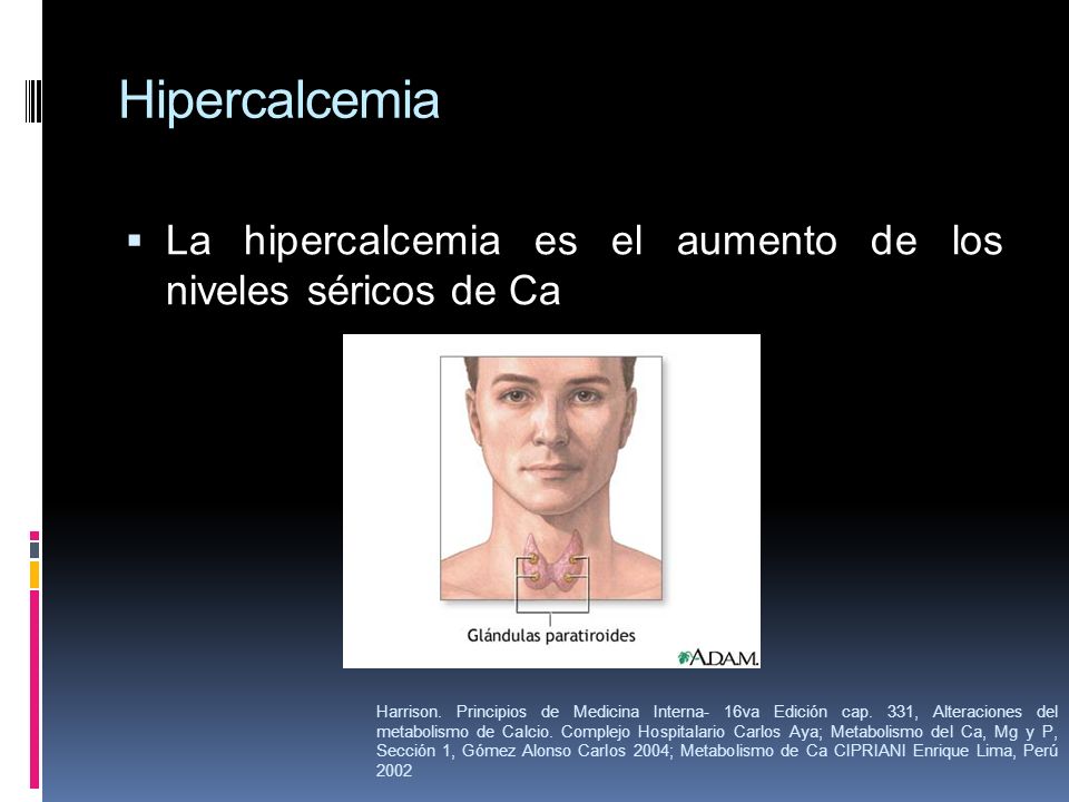 Hipercalcemia La hipercalcemia es el aumento de los niveles séricos de Ca.