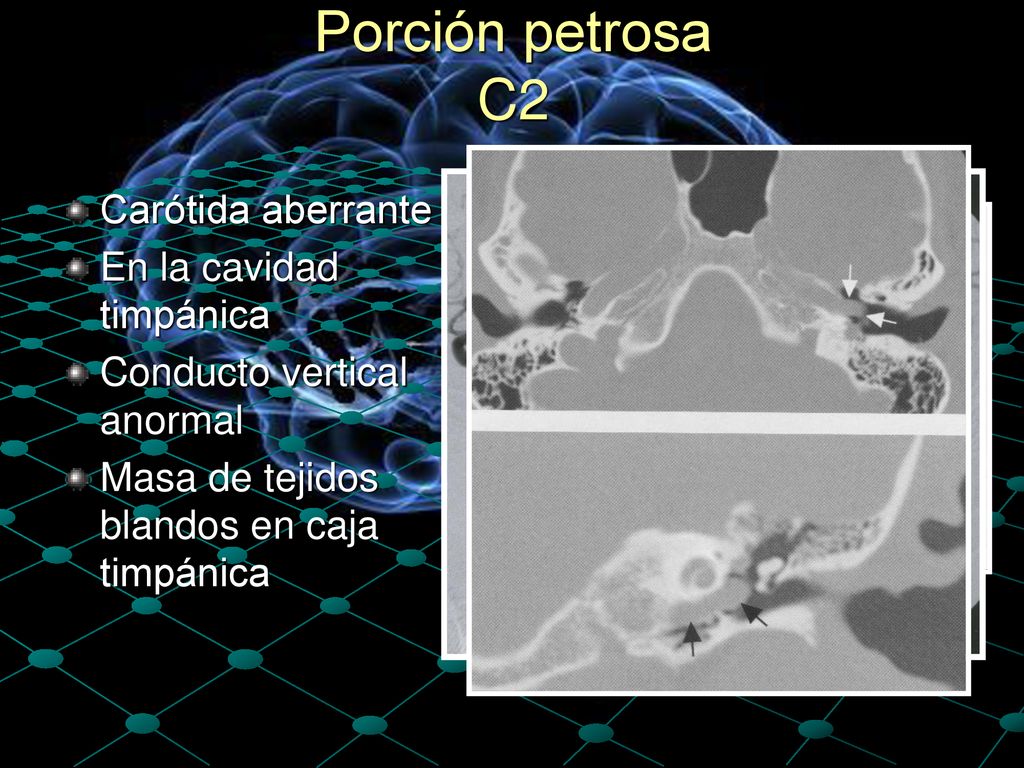 Porción petrosa C2 Carótida aberrante En la cavidad timpánica