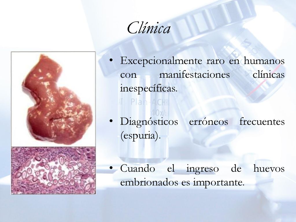Clínica Excepcionalmente raro en humanos con manifestaciones clínicas inespecíficas. Diagnósticos erróneos frecuentes (espuria).