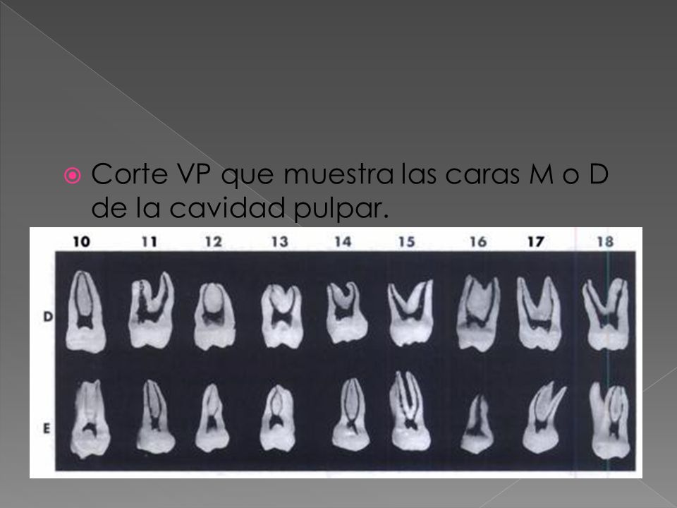 Corte VP que muestra las caras M o D de la cavidad pulpar.