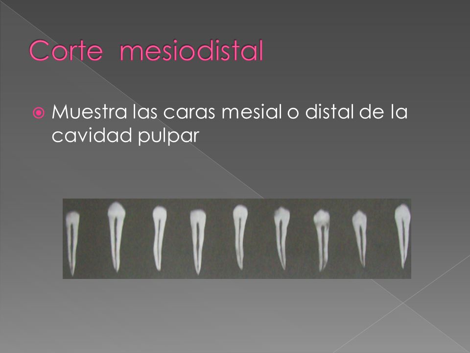 Corte mesiodistal Muestra las caras mesial o distal de la cavidad pulpar