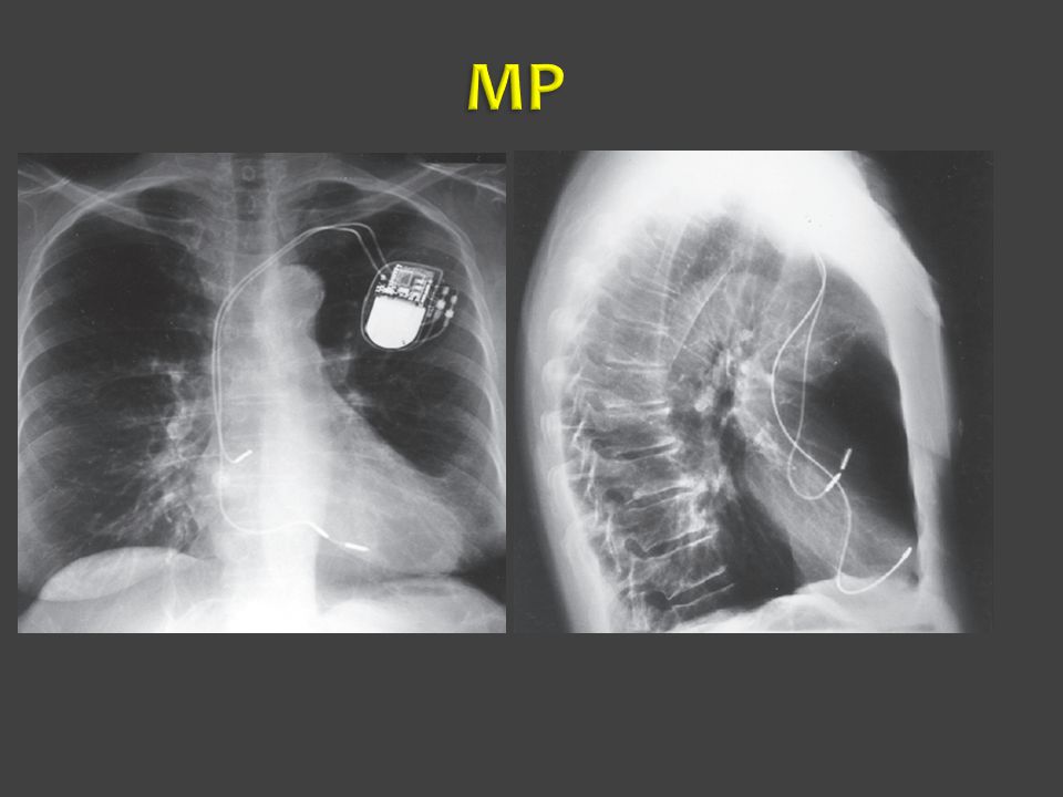 MP