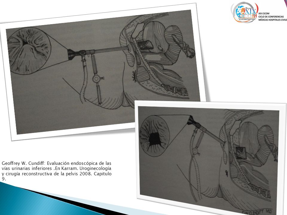 Geoffrey W. Cundiff: Evaluación endoscópica de las vías urinarias inferiores .En Karram.