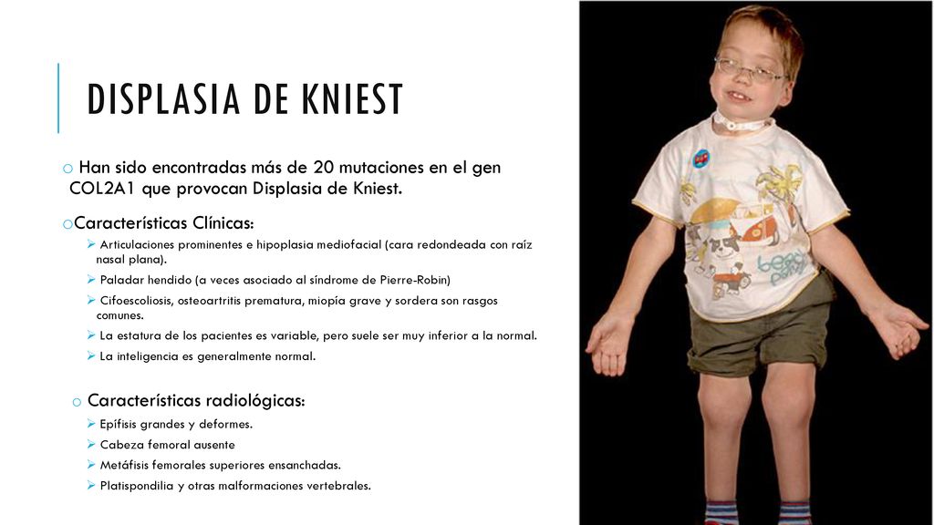 Displasia de kniest Han sido encontradas más de 20 mutaciones en el gen COL2A1 que provocan Displasia de Kniest.