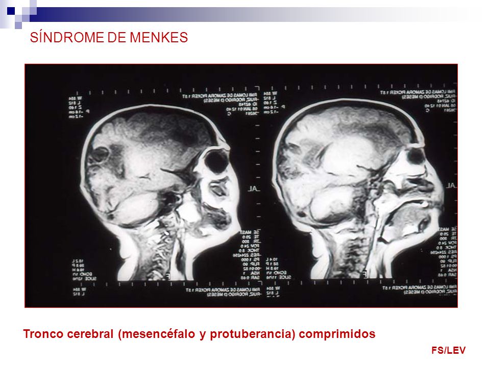 SÍNDROME DE MENKES Tronco cerebral (mesencéfalo y protuberancia) comprimidos FS/LEV