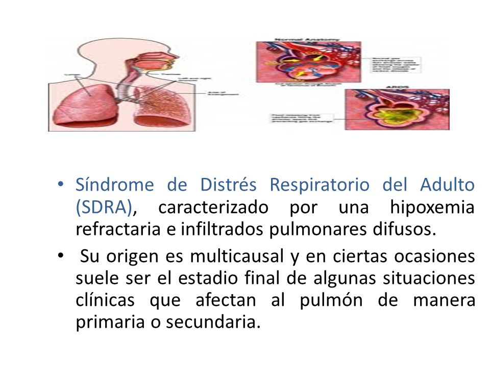 Síndrome de Distrés Respiratorio del Adulto (SDRA), caracterizado por una hipoxemia refractaria e infiltrados pulmonares difusos.