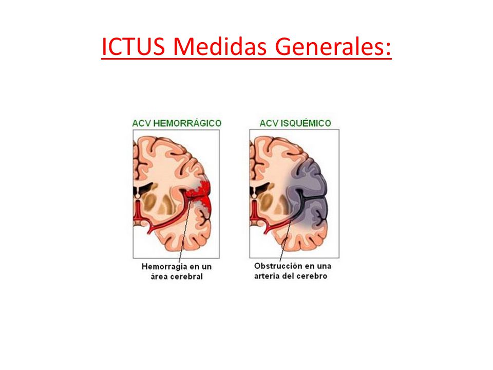 ICTUS Medidas Generales: