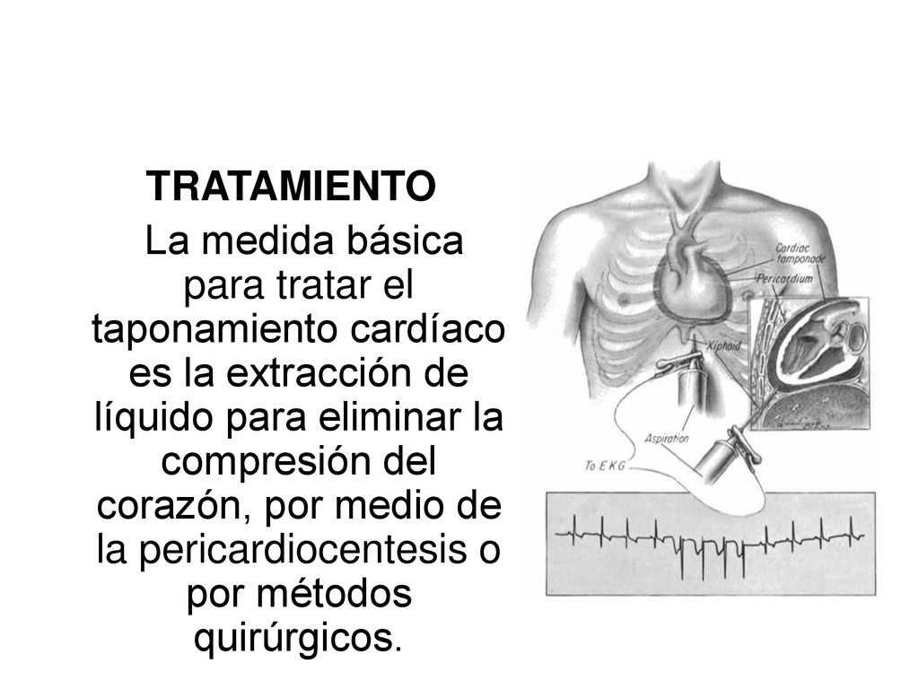 TRATAMIENTO La Medida Básica Para Tratar El Taponamiento Cardíaco Es La ...