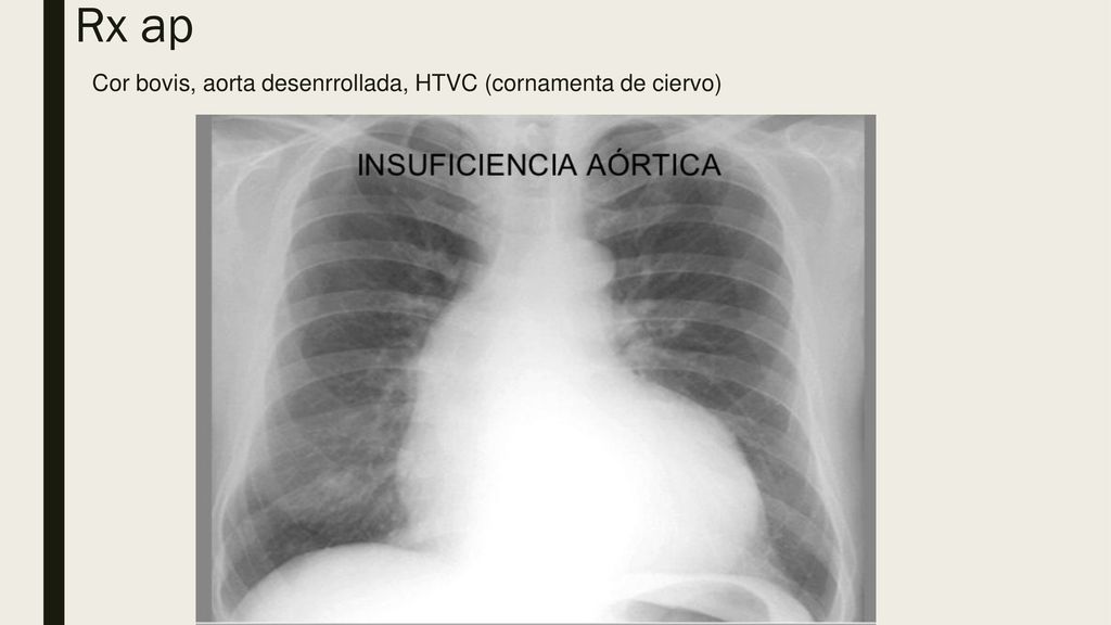 Rx ap Cor bovis, aorta desenrrollada, HTVC (cornamenta de ciervo)