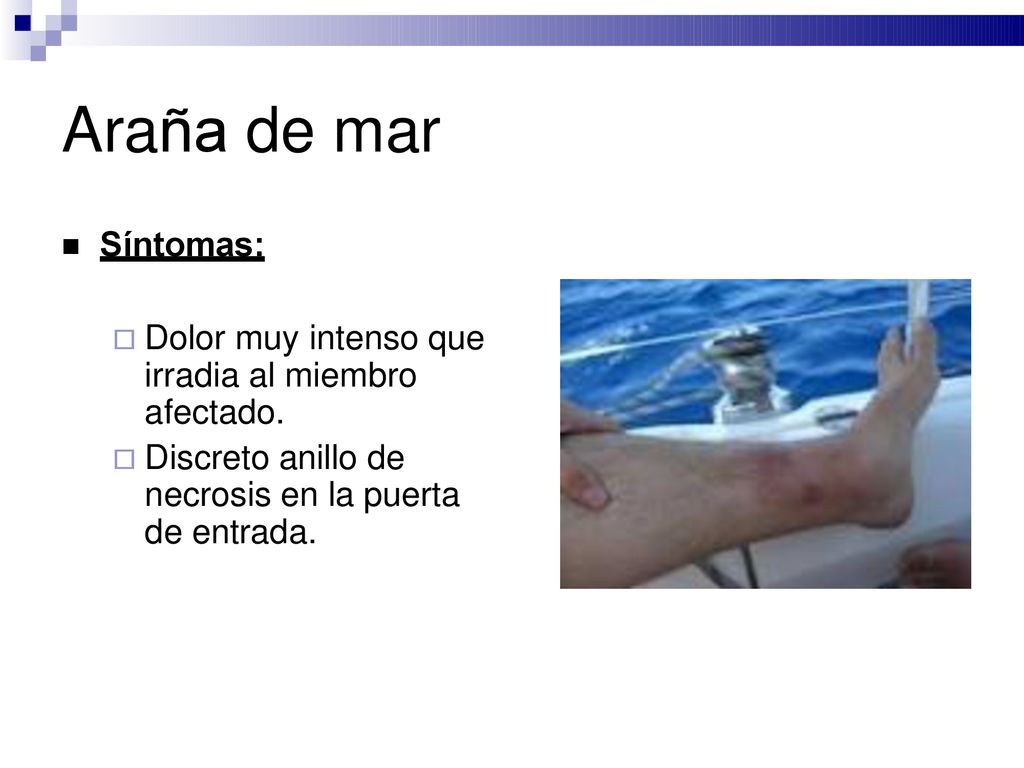 Araña de mar Síntomas: Dolor muy intenso que irradia al miembro afectado.