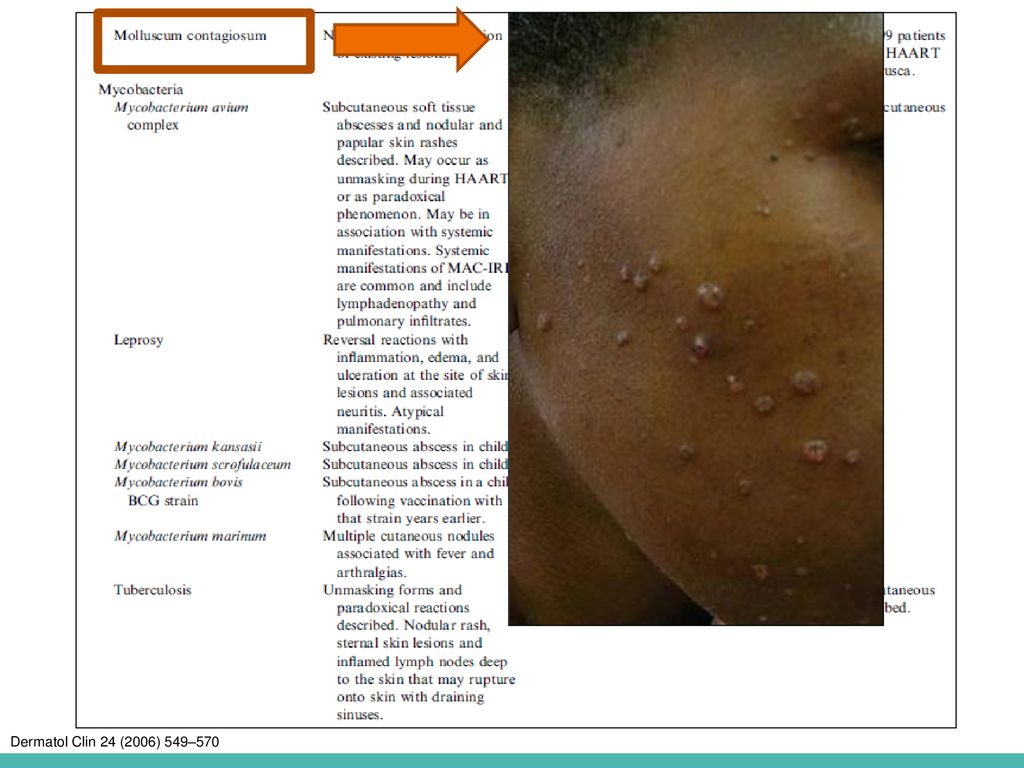 Fig. 2. Mollsucum contagiosum IRIS. This 25-year-old