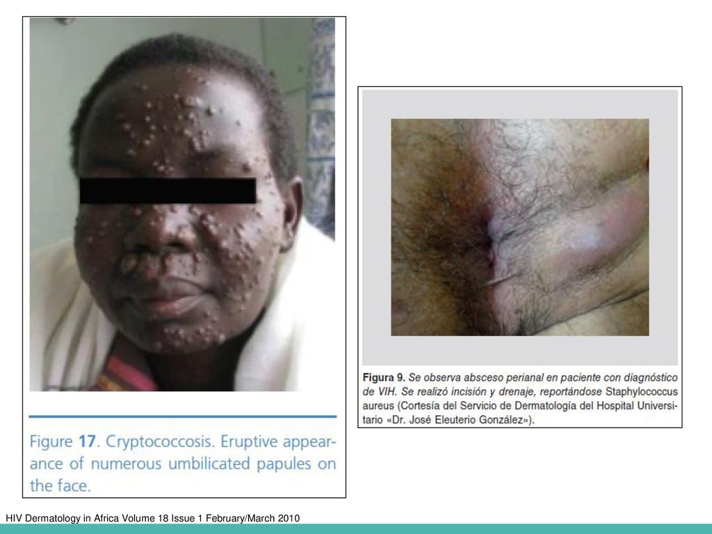 HIV Dermatology in Africa Volume 18 Issue 1 February/March 2010