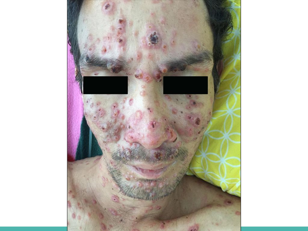 Histoplasmosis: Cutaneous lesions can take a number of forms from inflammatory folliculitis, molluscum-like papules, verrucous plaques, erythema multiforme-like lesions, vasculitic lesions, exfoliative dermatitis, ulcers and nodular lesions