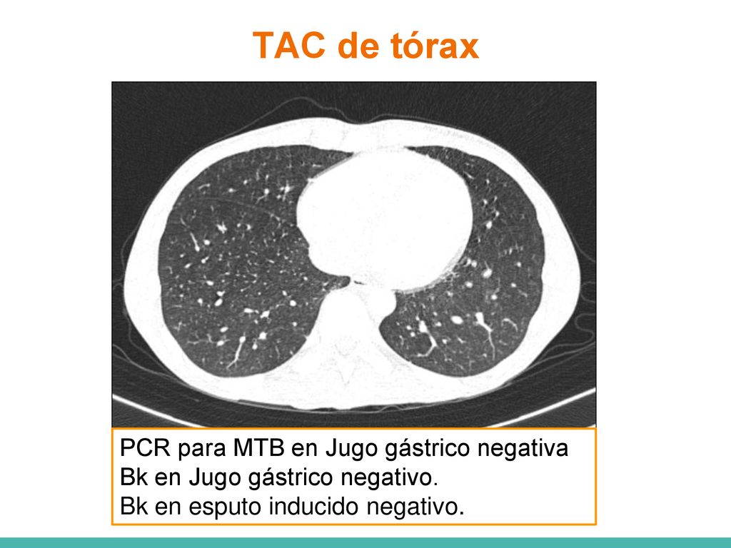 TAC de tórax PCR para MTB en Jugo gástrico negativa