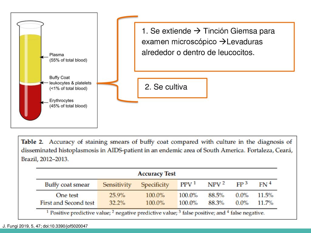 1. Se extiende  Tinción Giemsa para examen microscópico Levaduras alrededor o dentro de leucocitos.