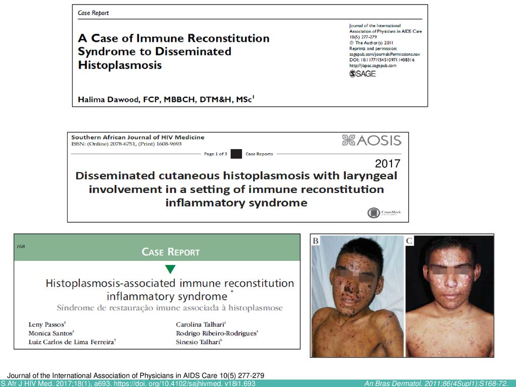 2017 Abstract. Histoplasmosis is an uncommon cause of hepatosplenomegaly in South Africa. A case of immune reconstitution syndrome (IRS) to.