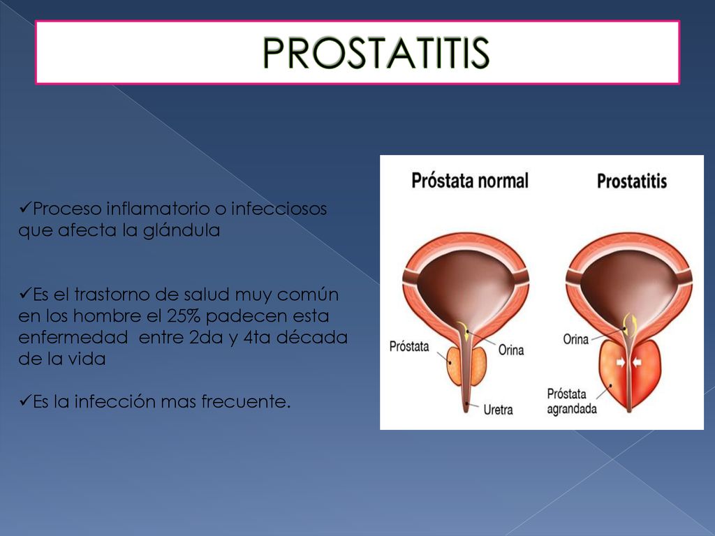 prostatitis és piramis)