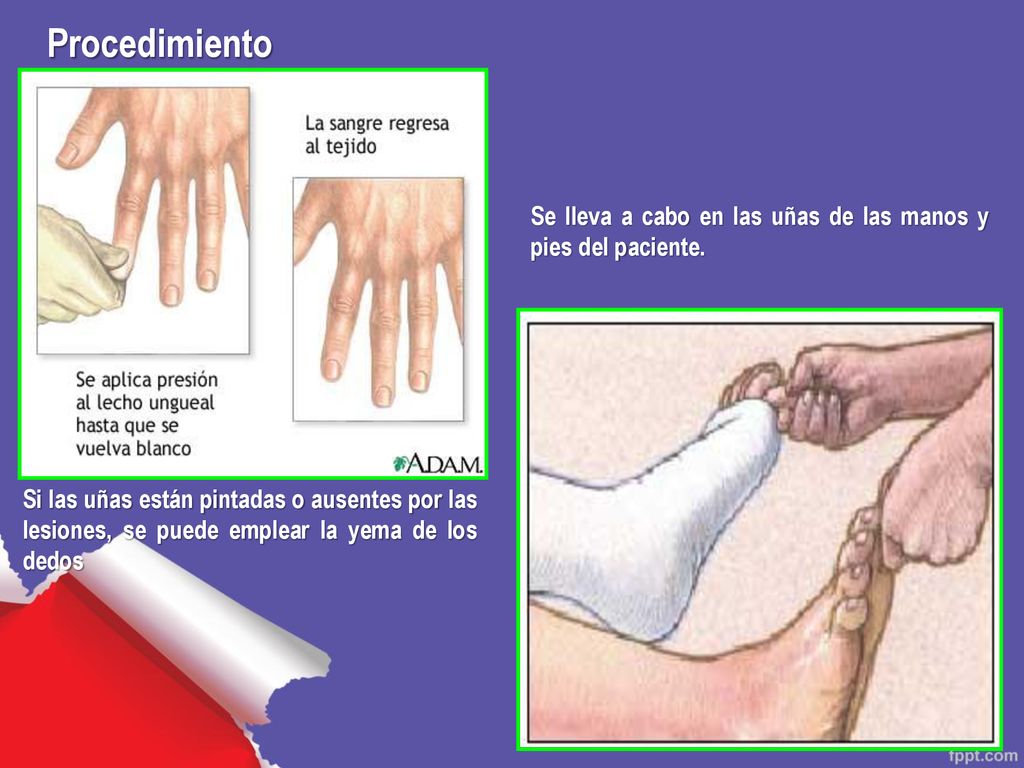 Procedimiento Se lleva a cabo en las uñas de las manos y pies del paciente.