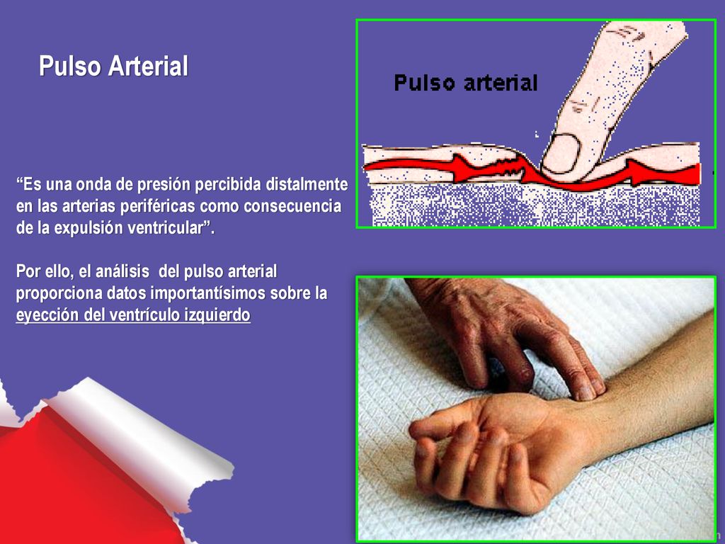 Pulso Arterial Es una onda de presión percibida distalmente en las arterias periféricas como consecuencia de la expulsión ventricular .