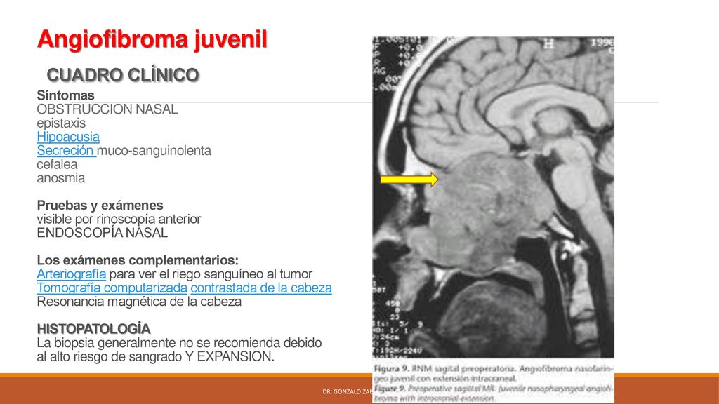 Angiofibroma juvenil CUADRO CLÍNICO Síntomas OBSTRUCCION NASAL epistaxis Hipoacusia Secreción muco-sanguinolenta cefalea anosmia Pruebas y exámenes visible por rinoscopía anterior ENDOSCOPÍA NASAL Los exámenes complementarios: Arteriografía para ver el riego sanguíneo al tumor Tomografía computarizada contrastada de la cabeza Resonancia magnética de la cabeza HISTOPATOLOGÍA La biopsia generalmente no se recomienda debido al alto riesgo de sangrado Y EXPANSION.