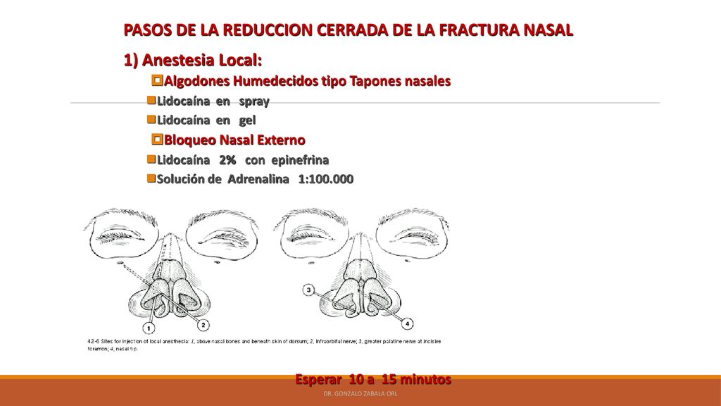 PASOS DE LA REDUCCION CERRADA DE LA FRACTURA NASAL 1) Anestesia Local: