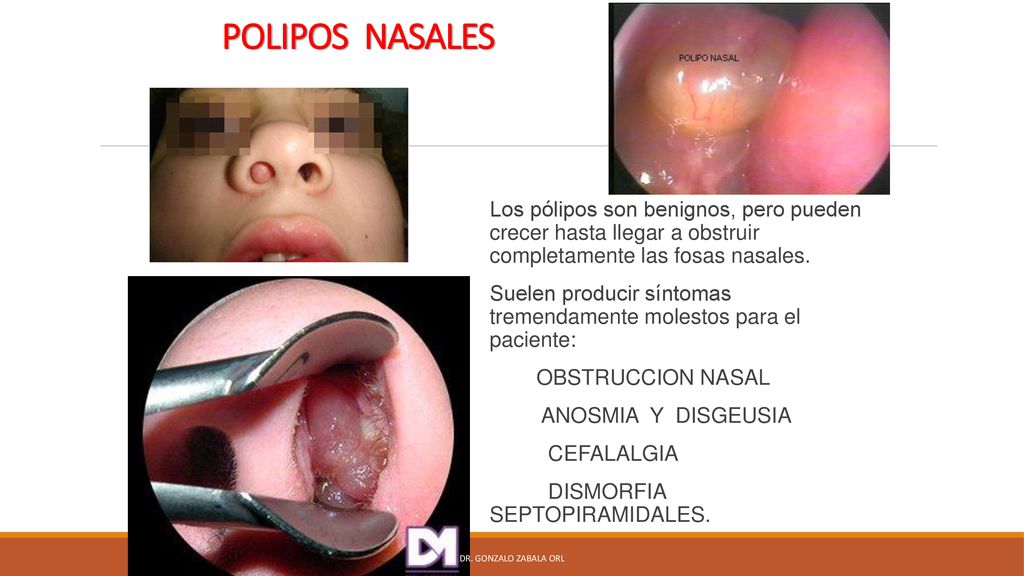 POLIPOS NASALES Los pólipos son benignos, pero pueden crecer hasta llegar a obstruir completamente las fosas nasales.