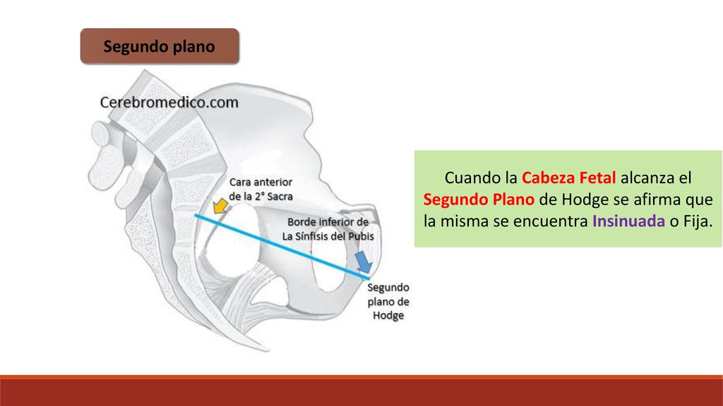 Segundo plano Cuando la Cabeza Fetal alcanza el Segundo Plano de Hodge se afirma que la misma se encuentra Insinuada o Fija.