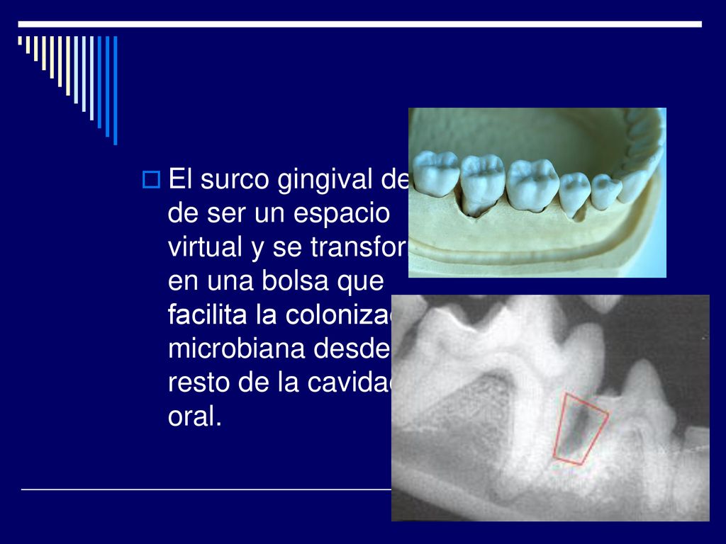 El surco gingival deja de ser un espacio virtual y se transforma en una bolsa que facilita la colonización microbiana desde el resto de la cavidad oral.