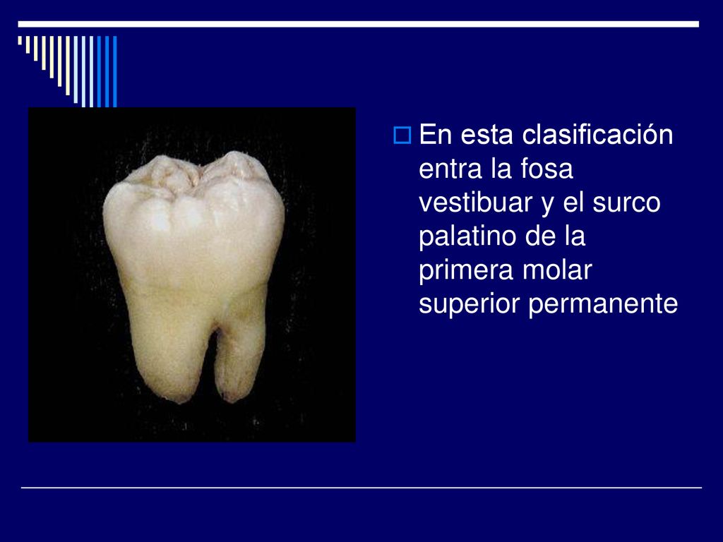 En esta clasificación entra la fosa vestibuar y el surco palatino de la primera molar superior permanente
