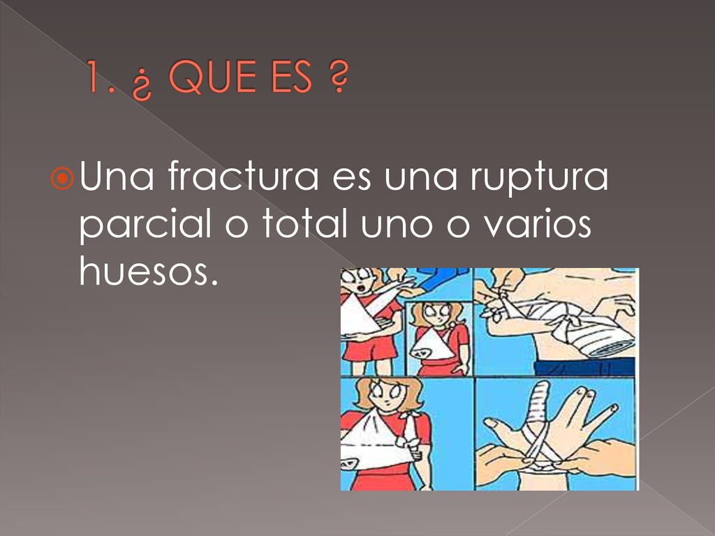 1. ¿ QUE ES Una fractura es una ruptura parcial o total uno o varios huesos.
