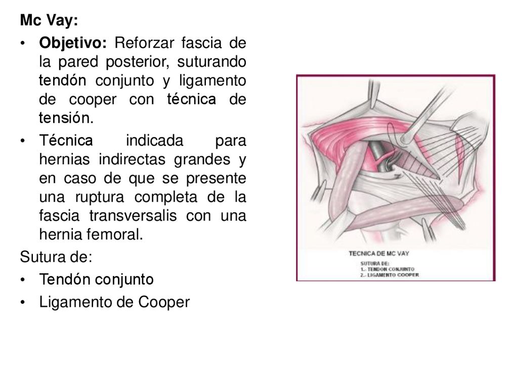 Mc Vay: Objetivo: Reforzar fascia de la pared posterior, suturando tendón conjunto y ligamento de cooper con técnica de tensión.