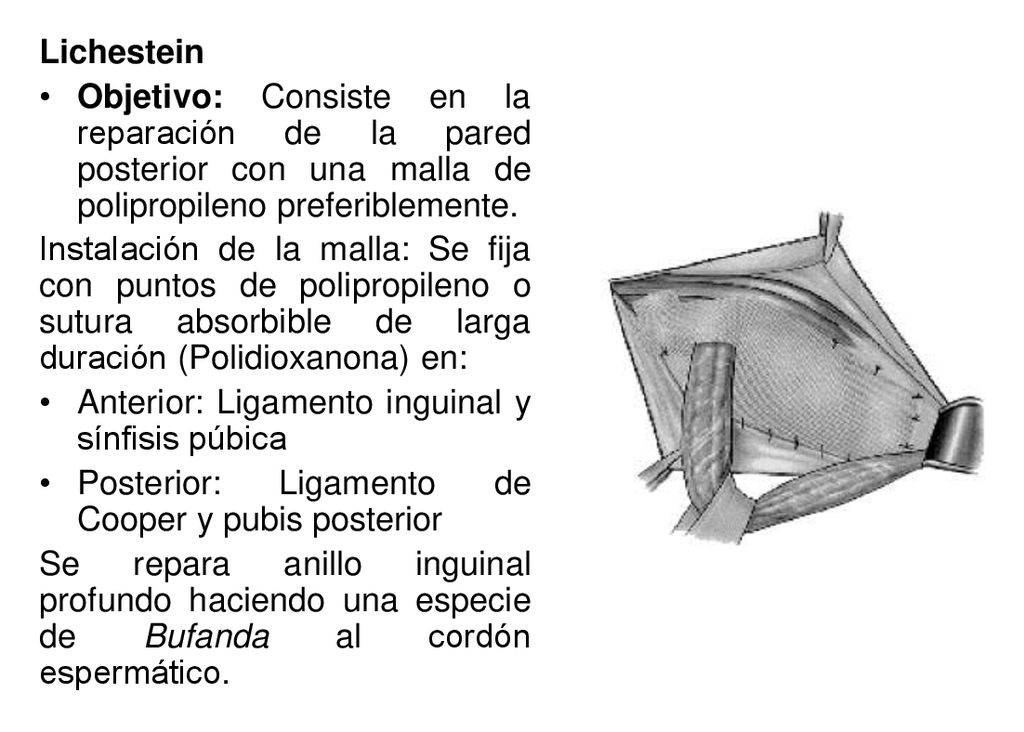 Lichestein Objetivo: Consiste en la reparación de la pared posterior con una malla de polipropileno preferiblemente.
