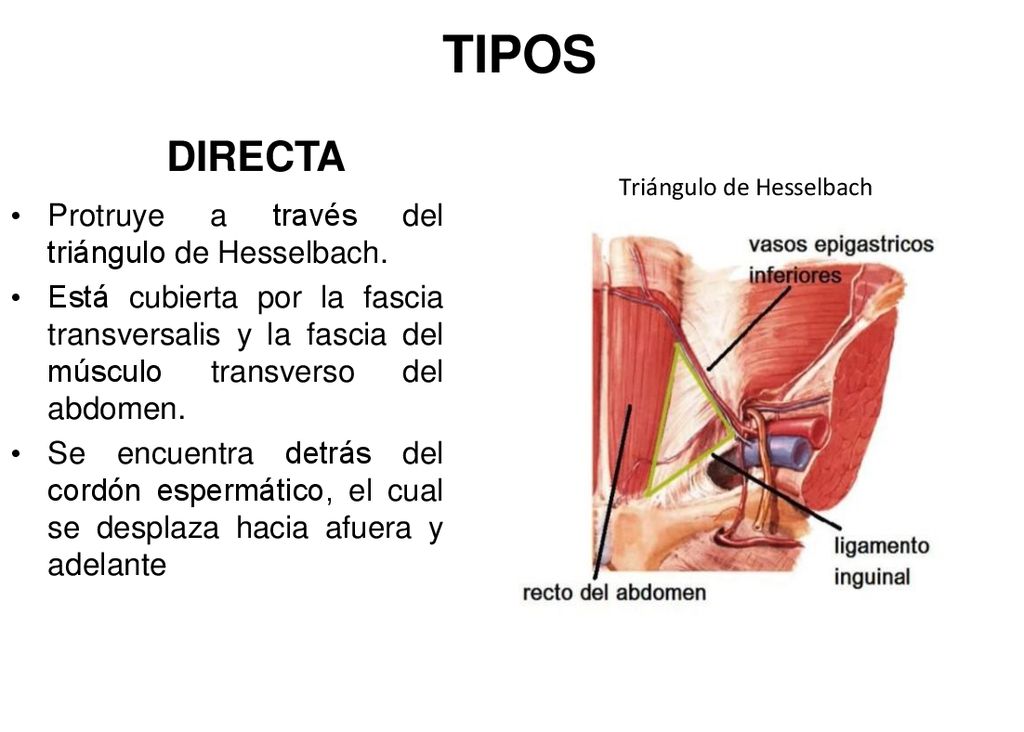 TIPOS DIRECTA Protruye a través del triángulo de Hesselbach.