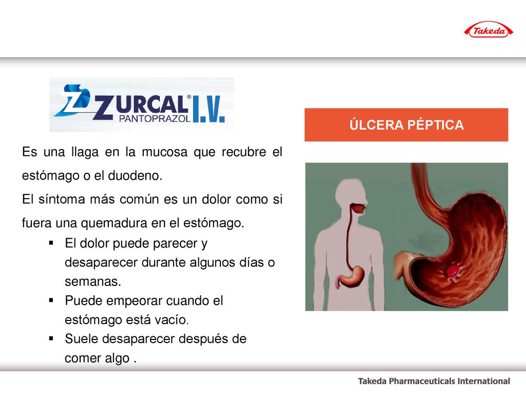 ÚLCERA PÉPTICA Es una llaga en la mucosa que recubre el estómago o el duodeno.