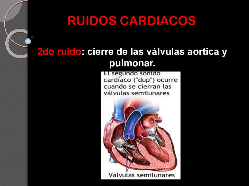 2do ruido: cierre de las válvulas aortica y pulmonar.