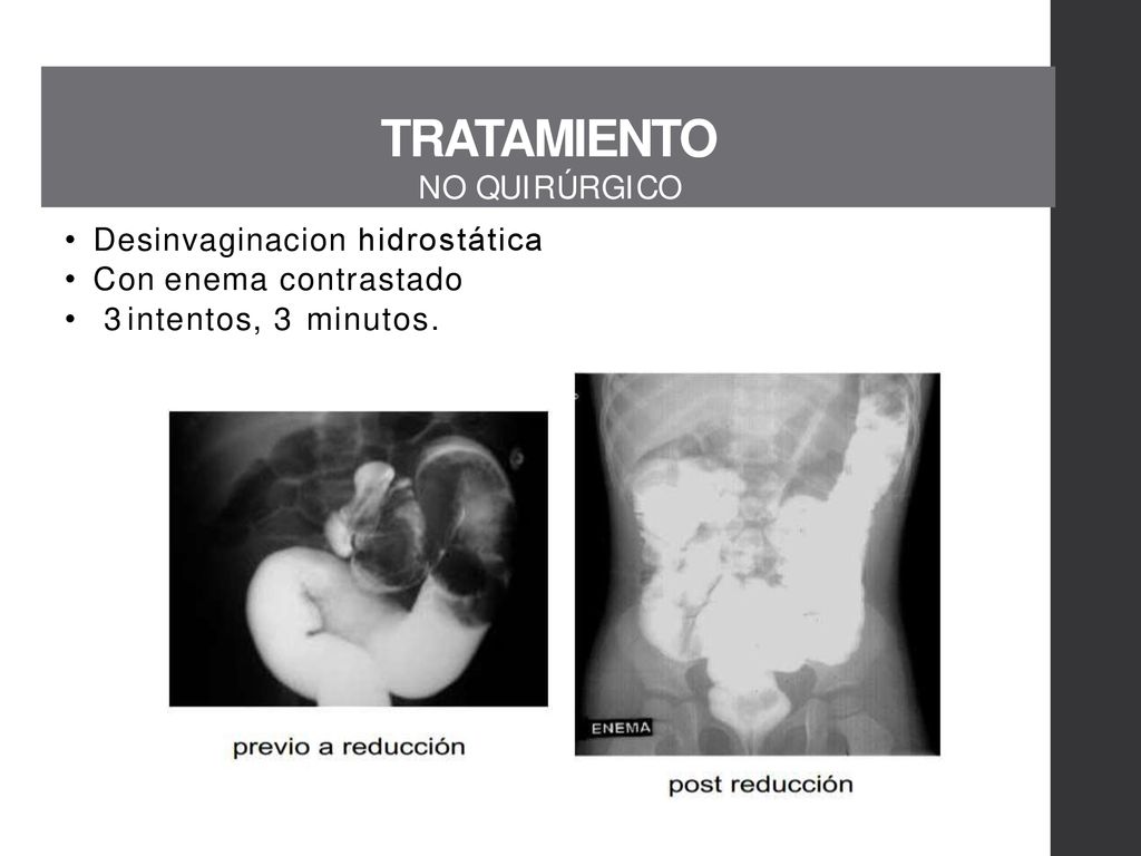 TRATAMIENTO N O Q U I R Ú R G I C O Desinvaginacion hidrostática