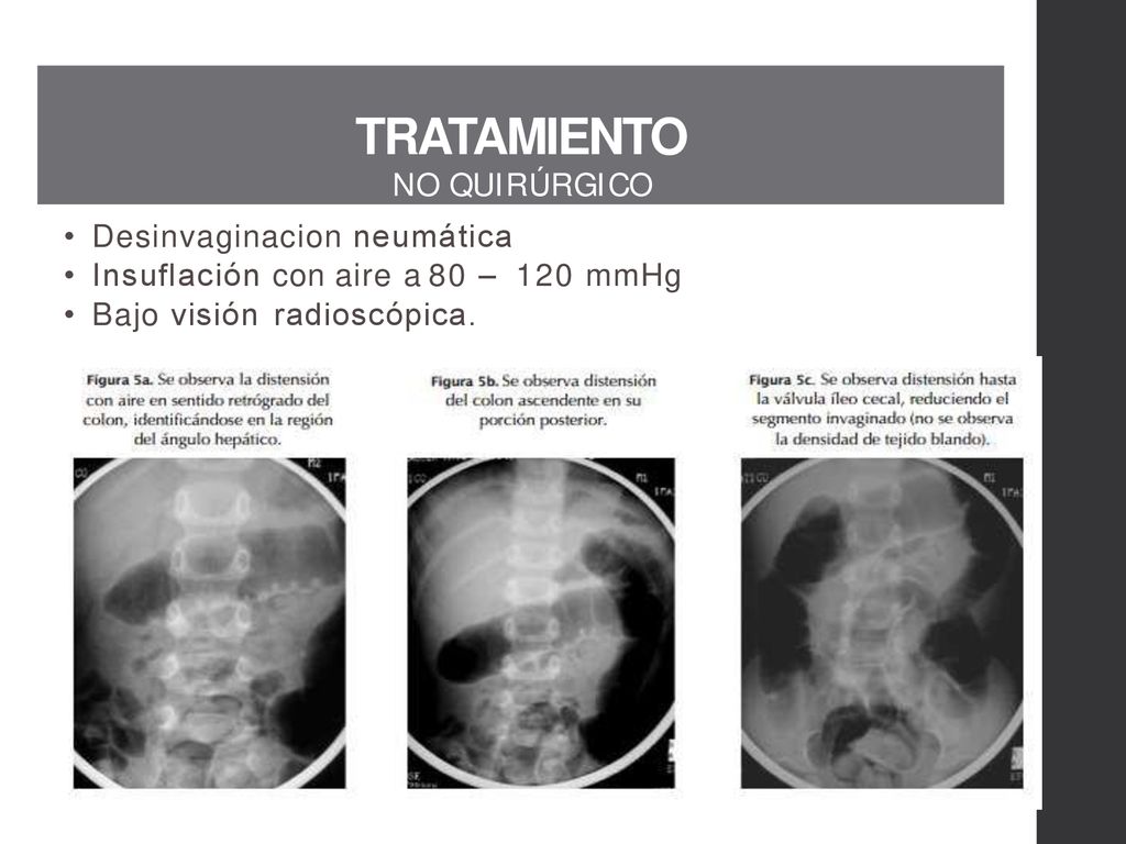 TRATAMIENTO N O Q U I R Ú R G I C O Desinvaginacion neumática