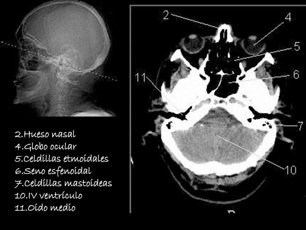 2.Hueso nasal 4.Globo ocular. 5.Celdillas etmoidales. 6.Seno esfenoidal. 7.Celdillas mastoideas.