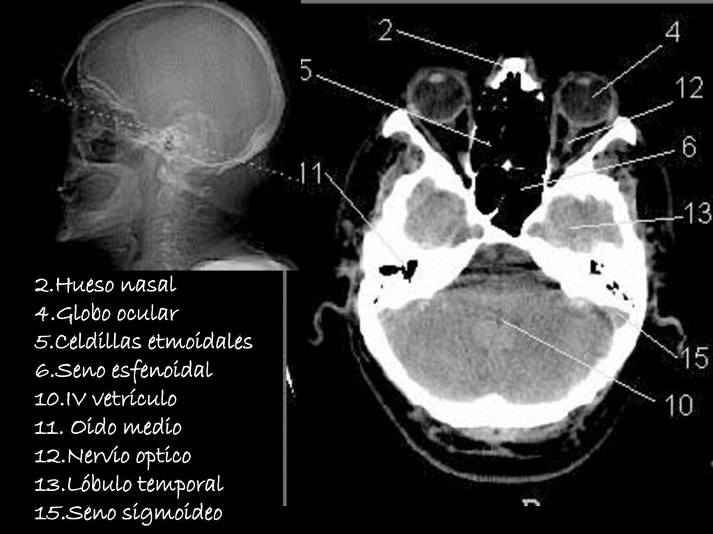 2.Hueso nasal 4.Globo ocular. 5.Celdillas etmoidales. 6.Seno esfenoidal. 10.IV vetrículo. 11. Oido medio.