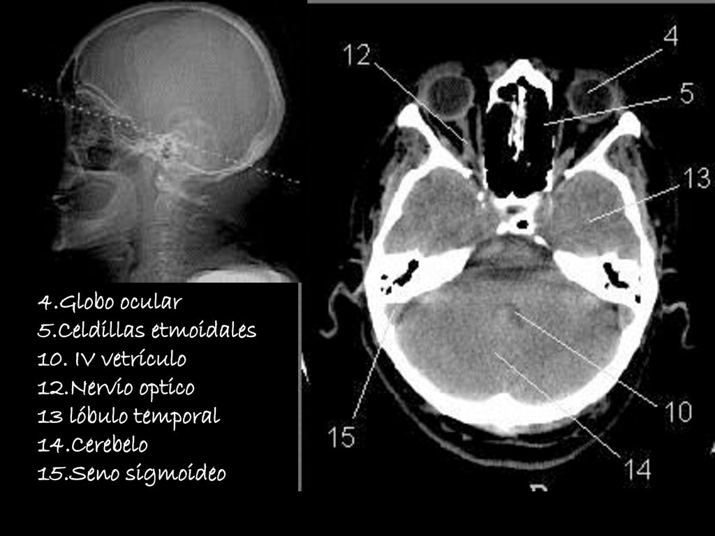 4.Globo ocular 5.Celdillas etmoidales. 10. IV vetrículo. 12.Nervio optico. 13 lóbulo temporal. 14.Cerebelo.