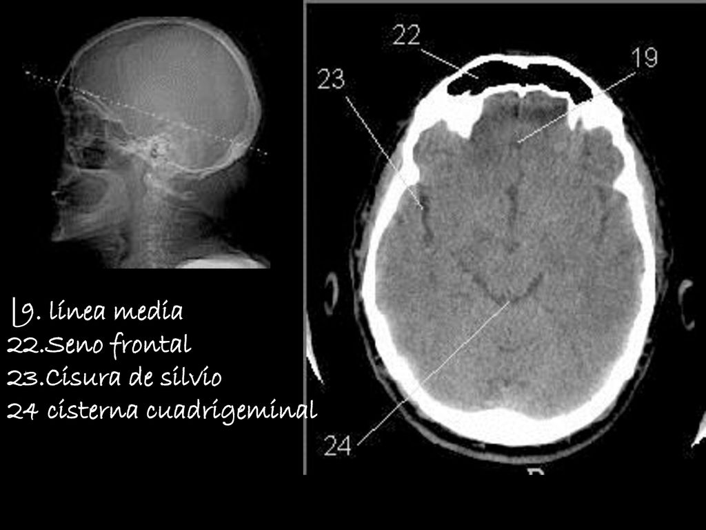 |9. línea media 22.Seno frontal 23.Cisura de silvio 24 cisterna cuadrigeminal