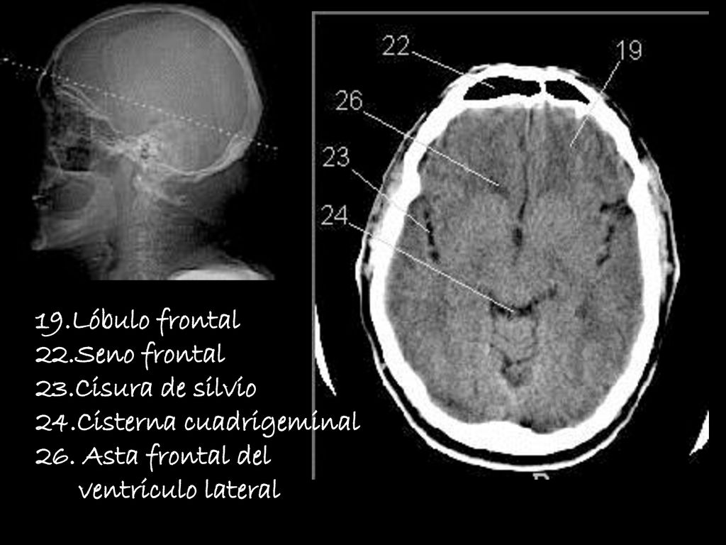19.Lóbulo frontal 22.Seno frontal. 23.Cisura de silvio. 24.Cisterna cuadrigeminal. 26. Asta frontal del.