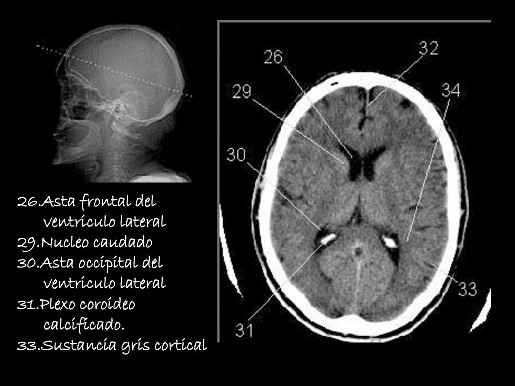 26.Asta frontal del ventriculo lateral. 29.Nucleo caudado. 30.Asta occipital del. 31.Plexo coroideo.