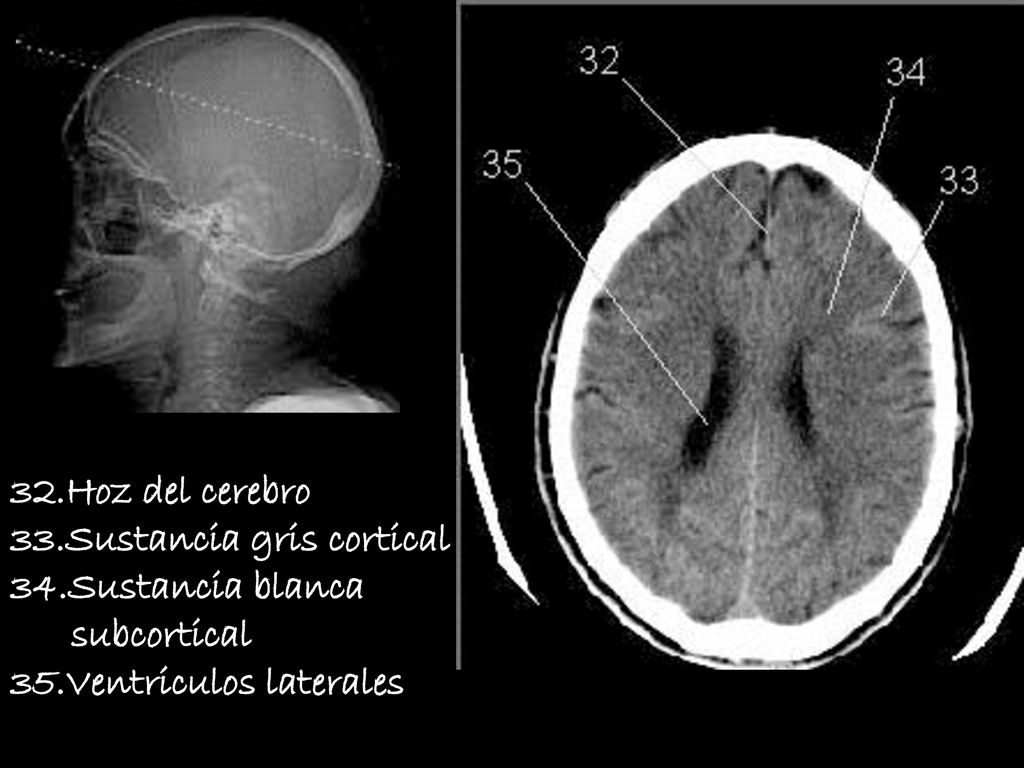 32.Hoz del cerebro 33.Sustancia gris cortical. 34.Sustancia blanca.