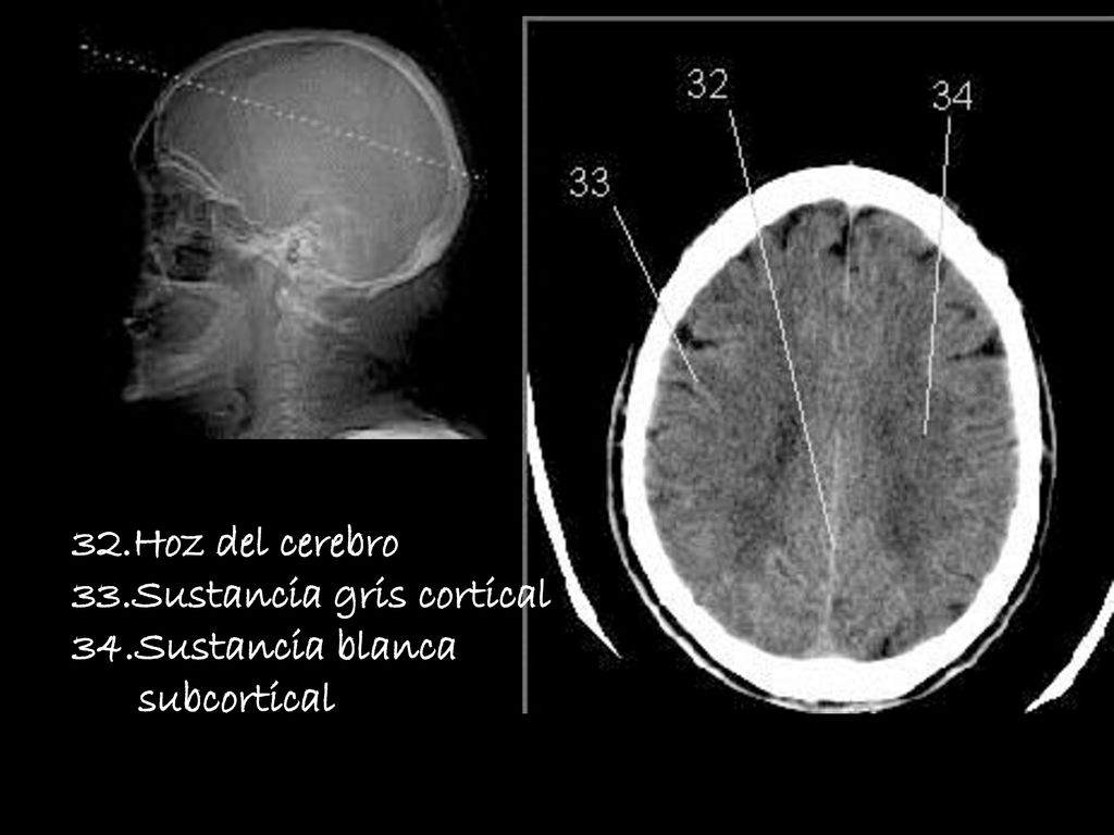 32.Hoz del cerebro 33.Sustancia gris cortical 34.Sustancia blanca subcortical